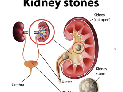 KIDNEY STONES AND ITS MANAGEMENT